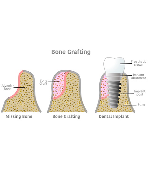 Illustration showing the results of bone grafting