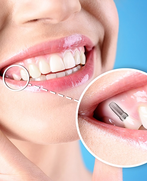 Close-up of woman’s smile with a dental implant