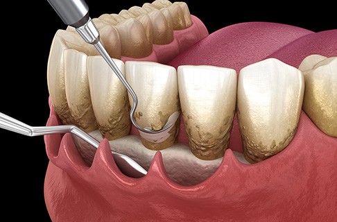 A 3D illustration of a scaling and root planing treatment