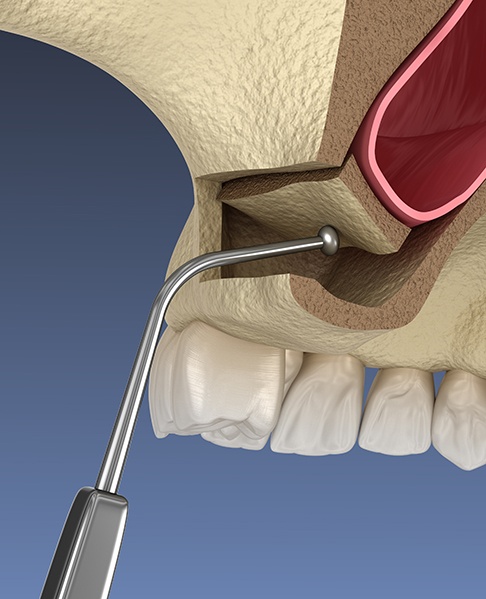 Illustration showing part of sinus lift procedure